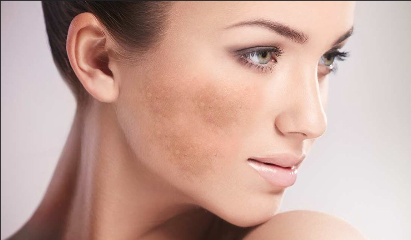 Tratamento para Melasma &agrave; Laser: Novidades na Dermatologia Est&eacute;tica