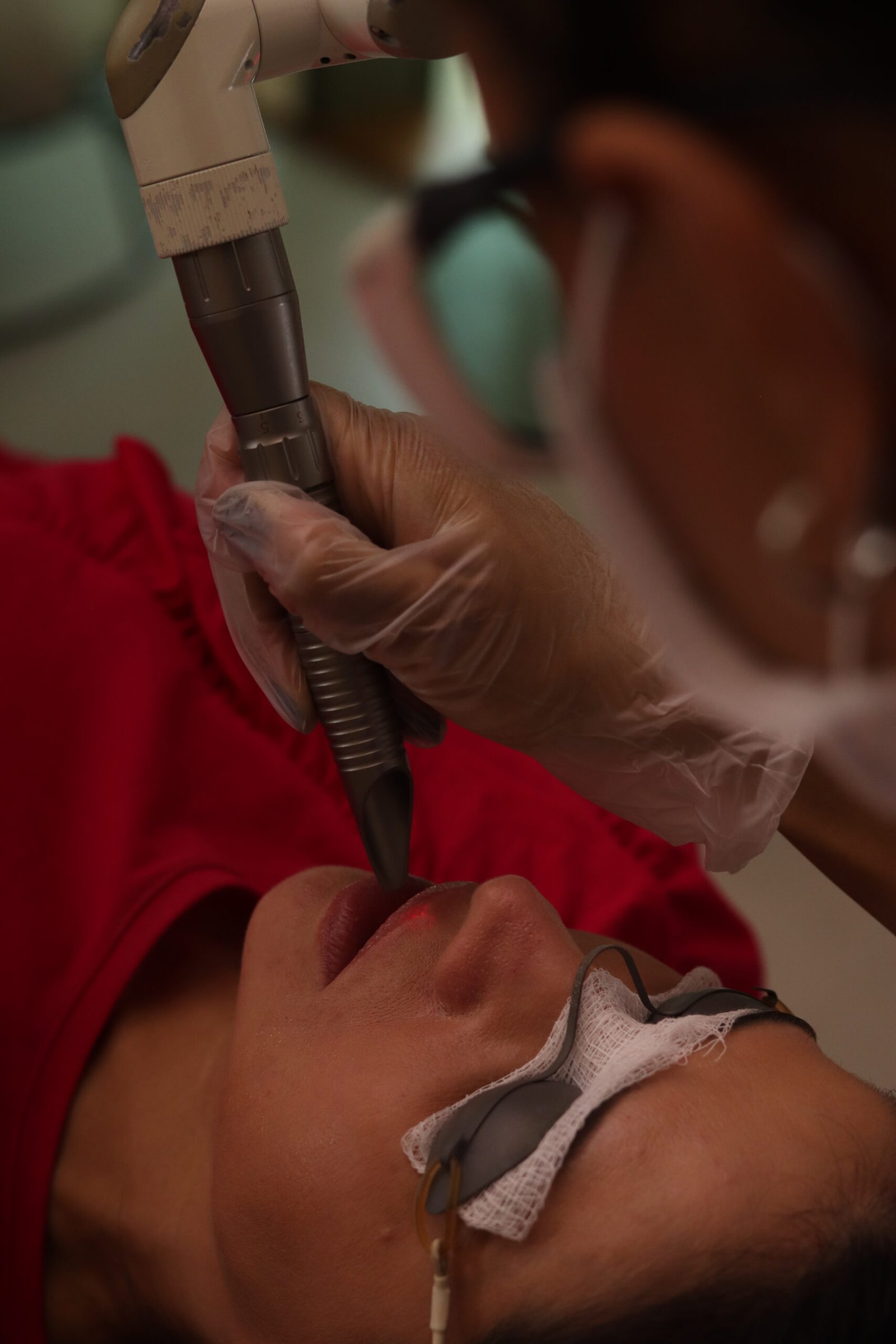 aplica&ccedil;&atilde;o do laser Fotona