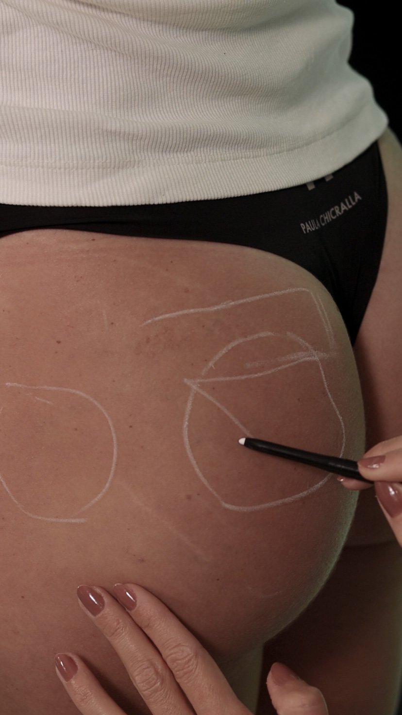 bioestimulador de col&aacute;geno